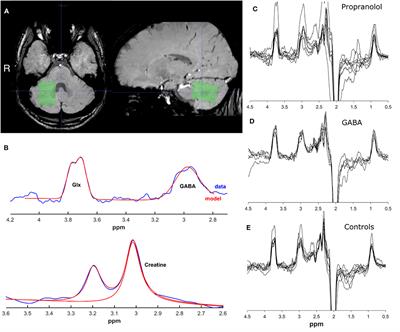 GABA, Glutamate, and NAA Levels in the Deep Cerebellar Nuclei of Essential Tremor Patients